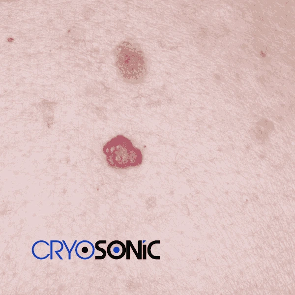 Looking for pain free cherry angioma removal treatment Eastbourne? Call our team today! Eastbourne