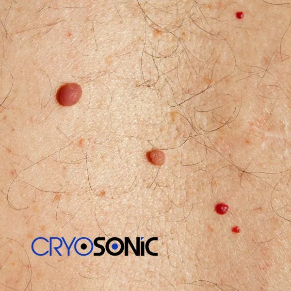get cherry angioma removal treatment today! Eastbourne