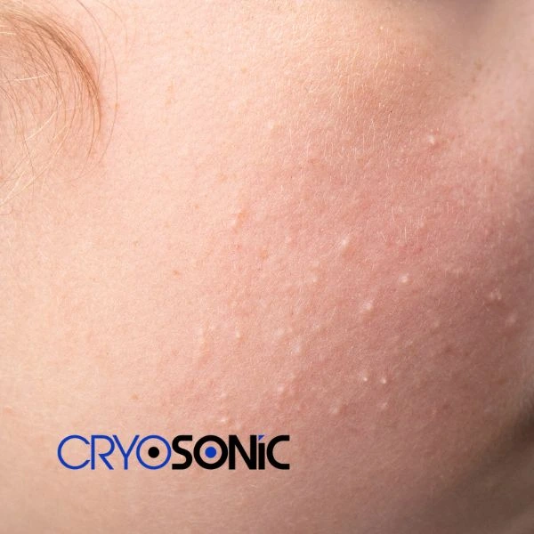 Are you looking for milia removal treatment? Contact our team today Eastbourne