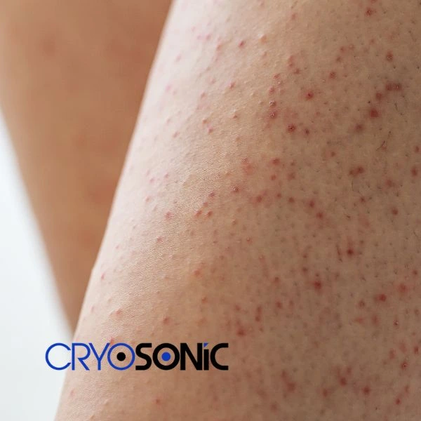 Looking for Seborrhoeic Keratosis removal Eastbourne treatment? Call our consultants today in Eastbourne