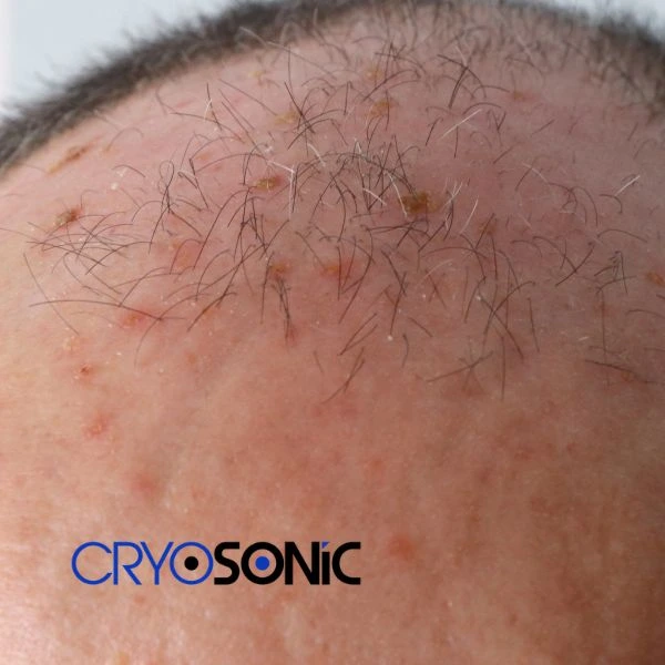 Access Seborrhoeic Keratosis removal from the comfort of your own home! Call us today in Eastbourne