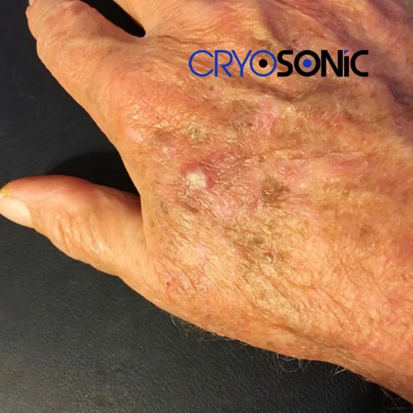 Understand more about actinic keratosis treatment today Eastbourne