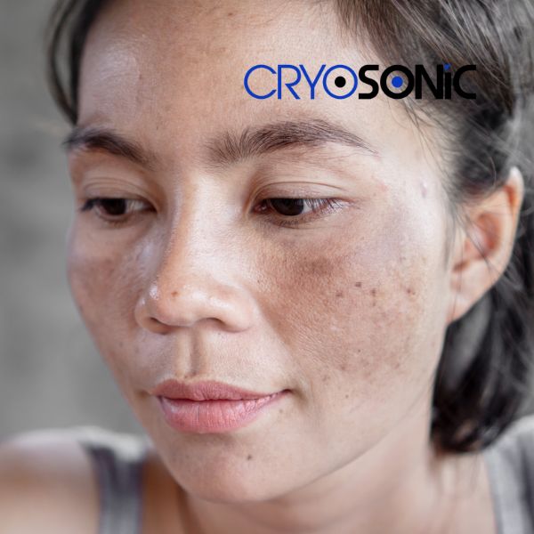 Ready to start age spots removal? Contact our team today in Eastbourne