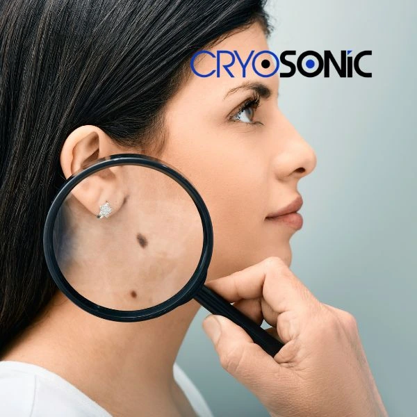Do you want to learn more about benign moles removal treatment? Call our team today Eastbourne