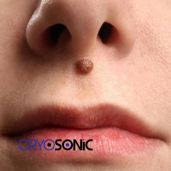 Start your benign moles removal treatment today Eastbourne