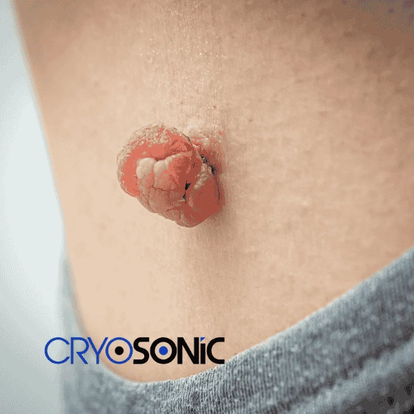 Book your skin tags removal Eastbourne from comfort of your own home! Eastbourne