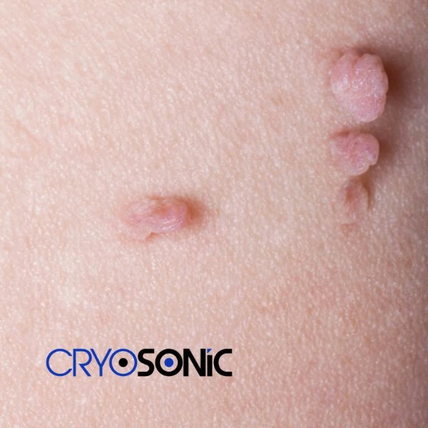 Are you looking for fast effect skin tag removal Eastbourne? Book in NOW! Eastbourne