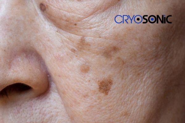 Protecting Your Skin from Sun Damage and Age Spots Eastbourne