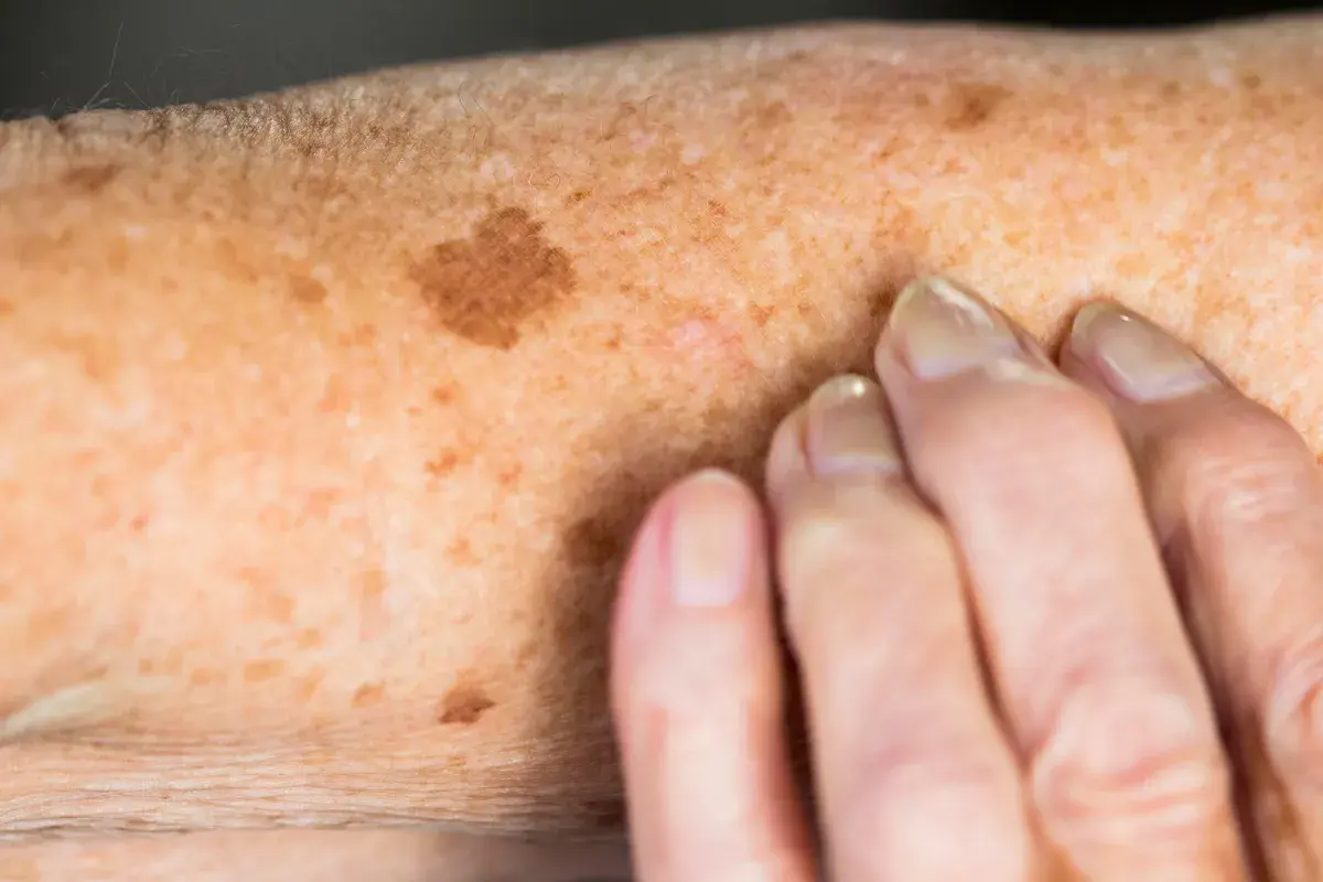 FAQs for Protecting Your Skin from Sun Damage Eastbourne