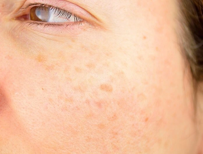 How Can Sun Protection Support Age Spot Treatments Eastbourne