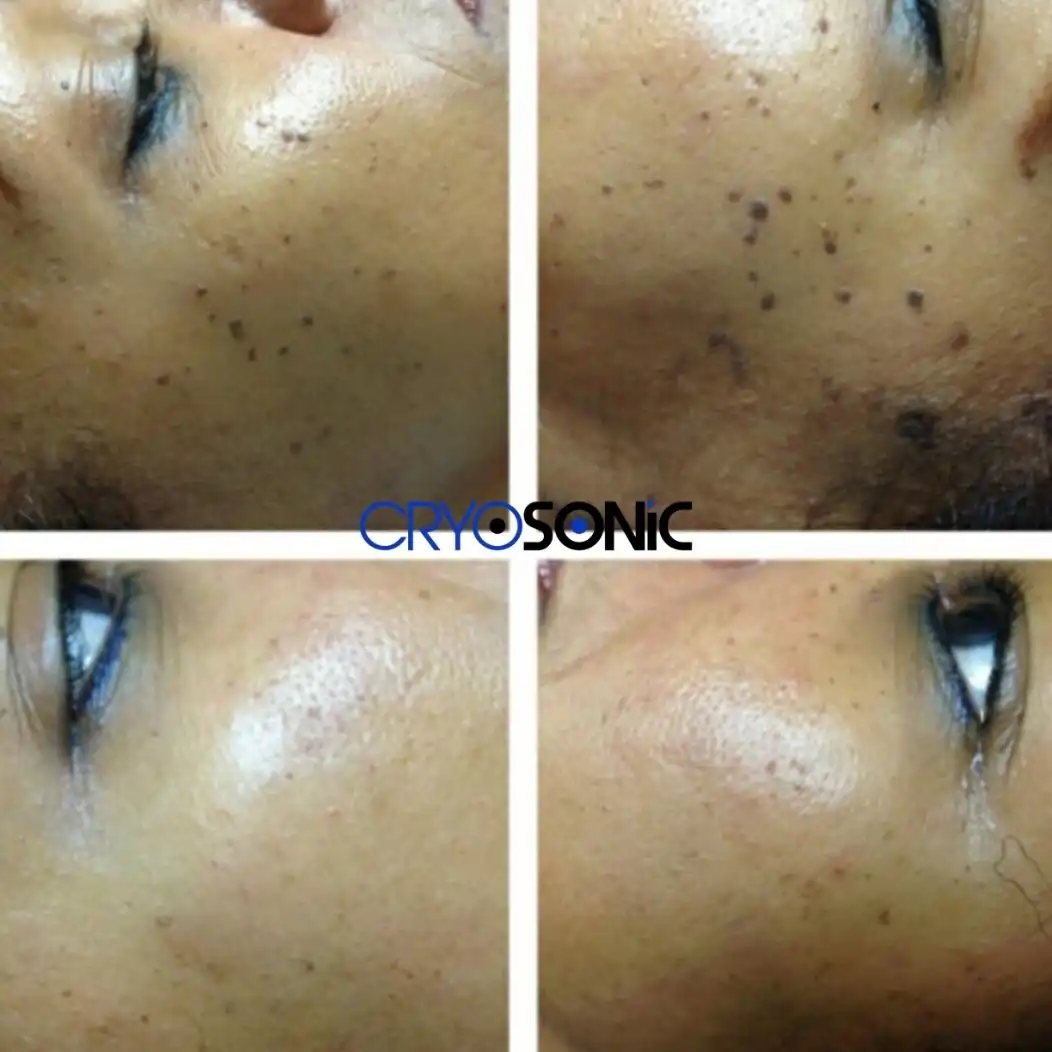Cryotherapy for Dark Skin: Pigmentation Risks and Specific Protocols Eastbourne