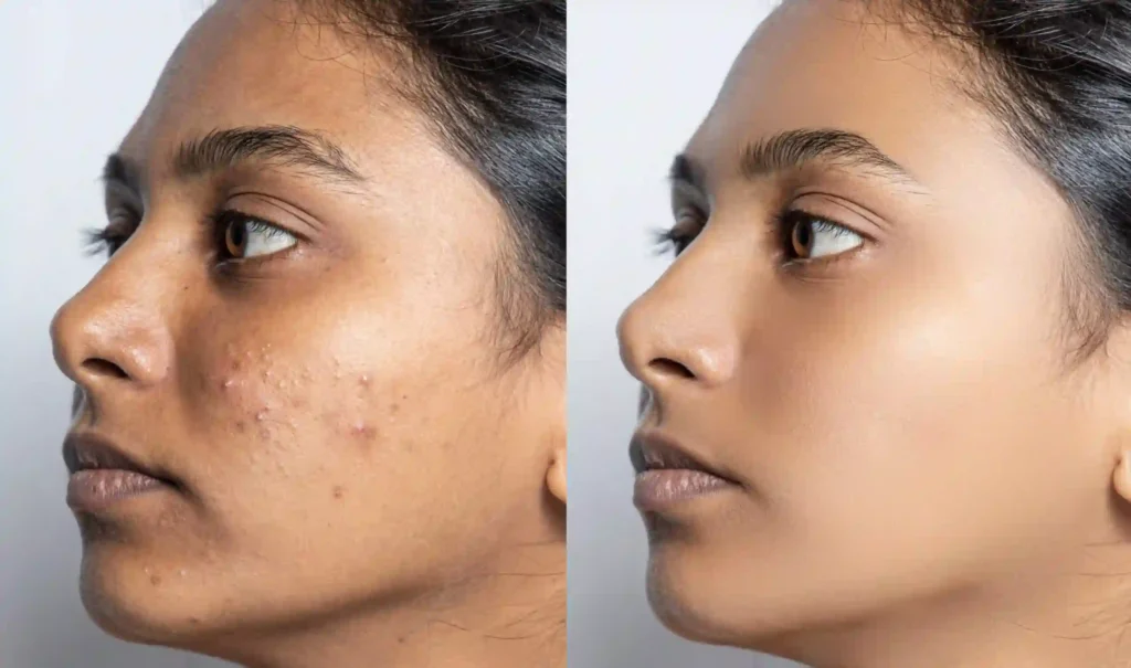 When Is Cryotherapy Not Recommended for Darker Skin Eastbourne