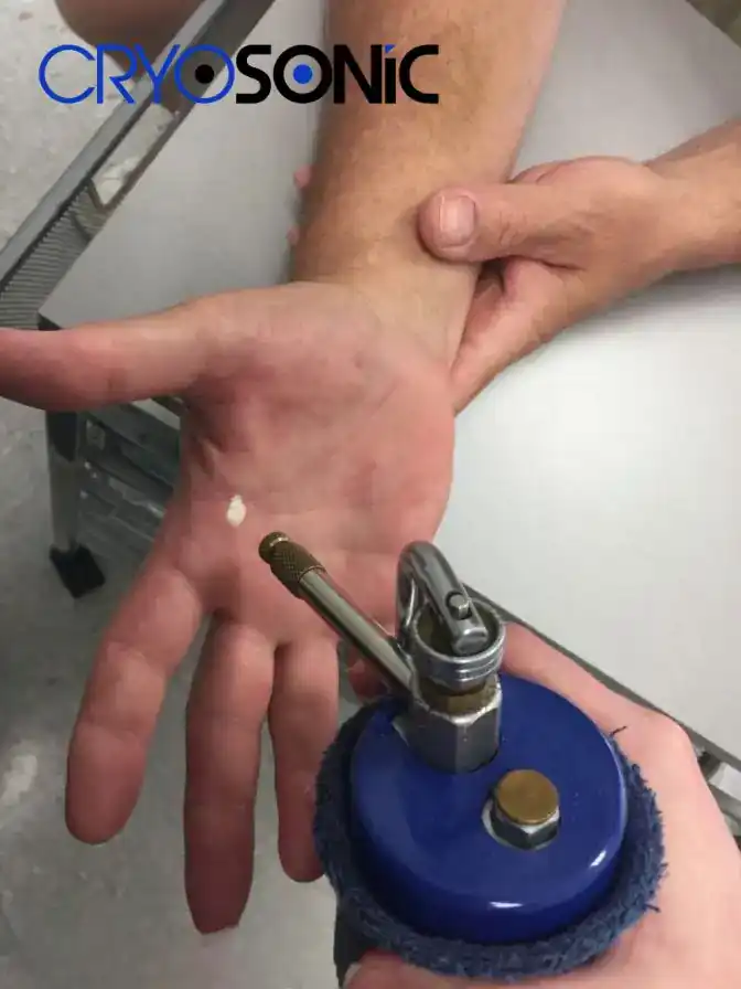 Temperature Differences: OTC vs Medical-Grade Cryotherapy Eastbourne